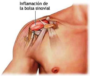 Trauma acumulativo