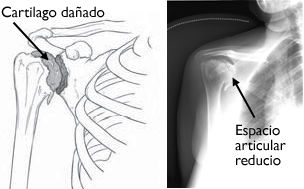 Trauma acumulativo