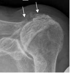 Trauma acumulativo