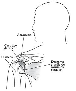 Trauma acumulativo