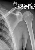 Trauma acumulativo