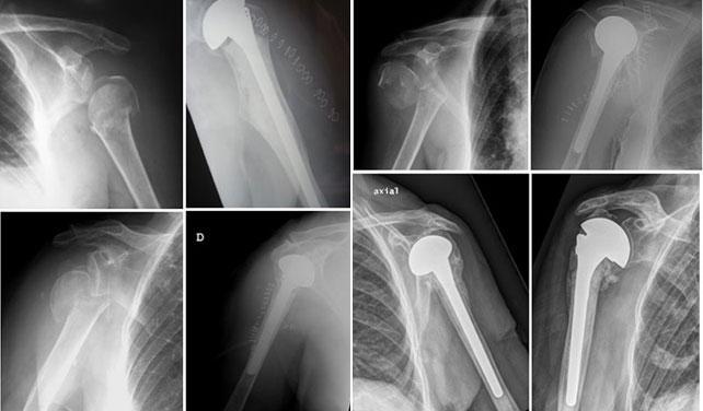 Trauma acumulativo
