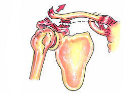 Trauma acumulativo