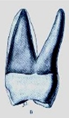 SEGUNDO Y TERCER MOLAR SUPERIOR PERMANENTE