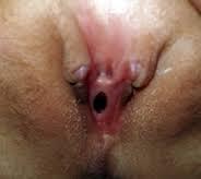 Anomalias Congenitas del Aparato Reproductor Femenino