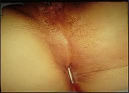 Anomalias Congenitas del Aparato Reproductor Femenino