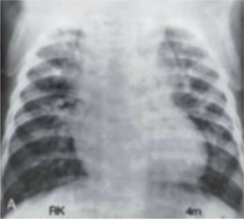 RETORNO VENOSO PULMONAR ANÓMALO TOTAL