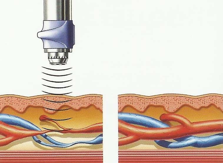 Tema 7. Terapia combinada y ondas de choque