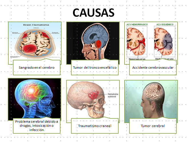 RESPUESTAS ANORMALES CEREBRALES MAPA MENTAL