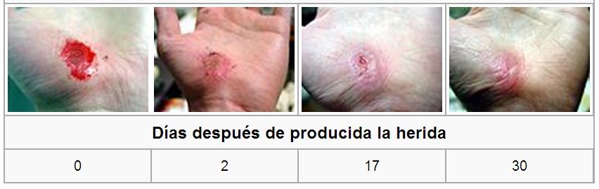 Tratamiento fisioterápico de la inflamación y de la cicatrización y reparación tisular