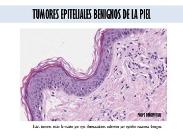 Tumores del SNC