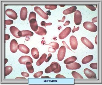 Eliptocitos: