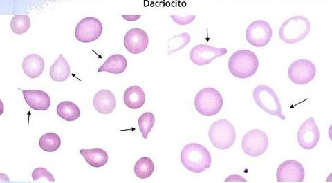 Dacriocitos (células en lágrima)