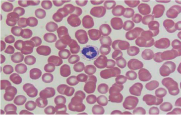 Trombocitopenia: