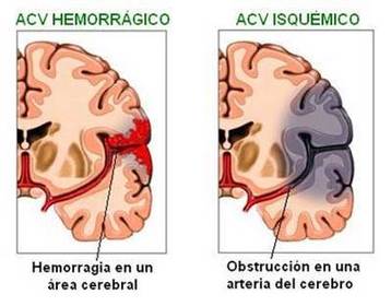 ACV en el lado izquierdo