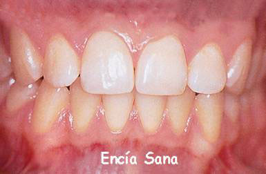 Características de la encía.