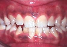 Presentación " EPIDEMIOLOGÍA DE LA ENFERMEDAD PERIODONTAL. "