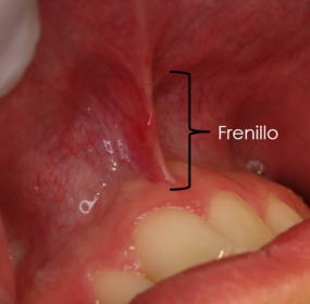 Presentación " EPIDEMIOLOGÍA DE LA ENFERMEDAD PERIODONTAL. "