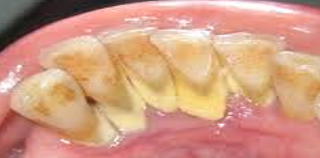 Presentación " EPIDEMIOLOGÍA DE LA ENFERMEDAD PERIODONTAL. "