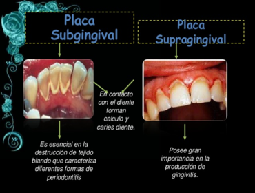 Clasificación por localización de la placa.