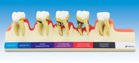 Clasificación de la enfermedad periodontal.