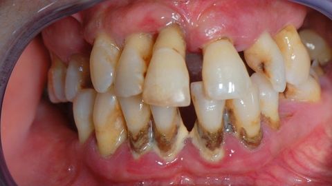 Presentación " EPIDEMIOLOGÍA DE LA ENFERMEDAD PERIODONTAL. "