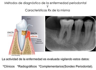 Presentación " EPIDEMIOLOGÍA DE LA ENFERMEDAD PERIODONTAL. "