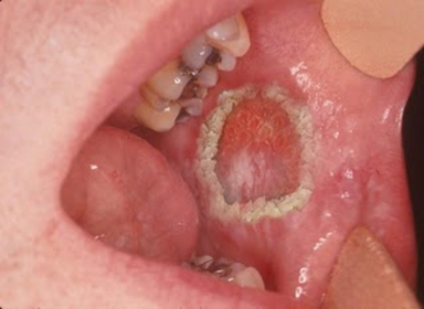Síntomas del cáncer bucal.