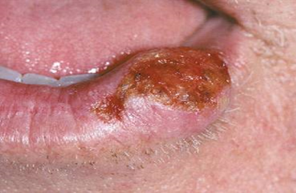 Presentación "EPIDEMIOLOGÍA DEL CÁNCER BUCAL".