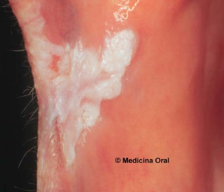 Leucoplasia de la mucosa bucal (LMB).