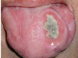 Presentación "EPIDEMIOLOGÍA DEL CÁNCER BUCAL".