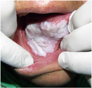 Presentación "EPIDEMIOLOGÍA DEL CÁNCER BUCAL".