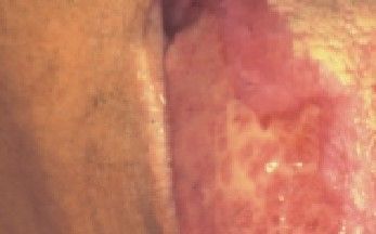 Presentación "EPIDEMIOLOGÍA DEL CÁNCER BUCAL".