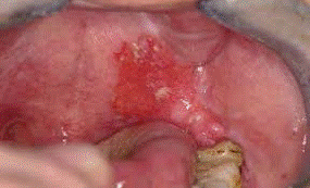 Presentación "EPIDEMIOLOGÍA DEL CÁNCER BUCAL".
