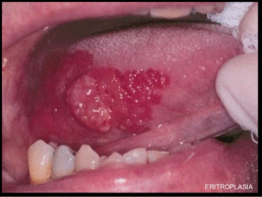 Presentación "EPIDEMIOLOGÍA DEL CÁNCER BUCAL".