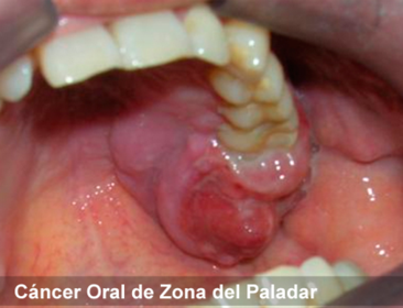 Presentación "EPIDEMIOLOGÍA DEL CÁNCER BUCAL".