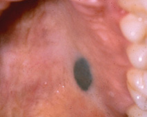 Presentación "EPIDEMIOLOGÍA DEL CÁNCER BUCAL".