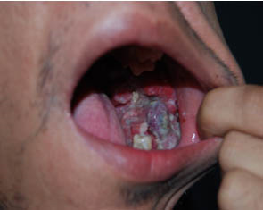 Presentación "EPIDEMIOLOGÍA DEL CÁNCER BUCAL".